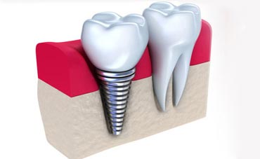 dental-implant